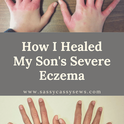 How I Healed My Son’s Severe Eczema